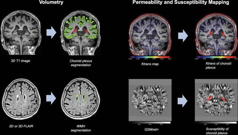 MRI Choroid Plexus Volume Linked to Alzheimer’s Disease