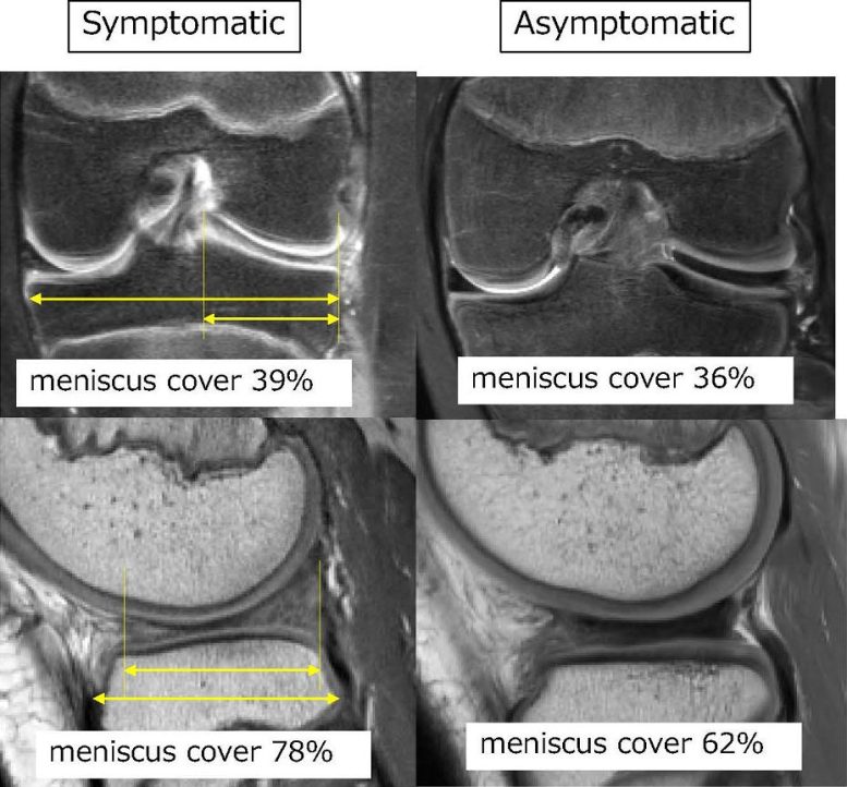 MRI Comparisons of the Symptomatic and Asymptomatic Groups
