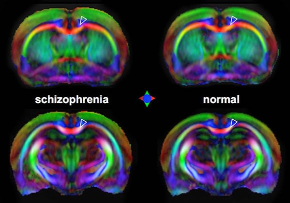 MRI Detects Early Signs of Schizophrenia