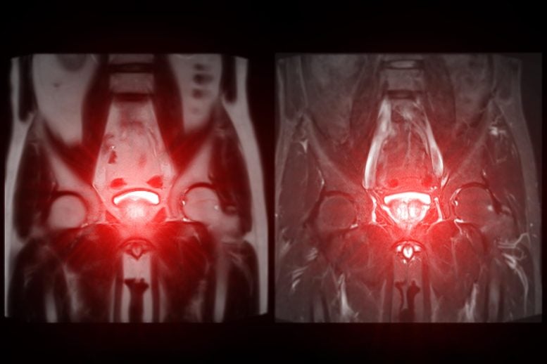 MRI Enlarged Prostate Gland