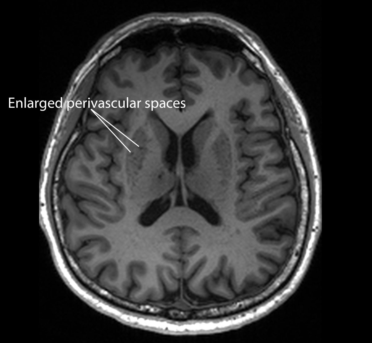 Scientists Discover Early Alzheimer’s Warning Sign Hiding in Routine ...