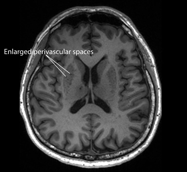 MRI Image of a Patient With Enlarged Perivascular Spaces