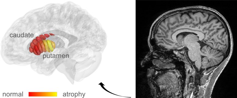 MRI Images Parkinson's