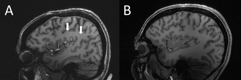 MRI Migraine Brain Changes