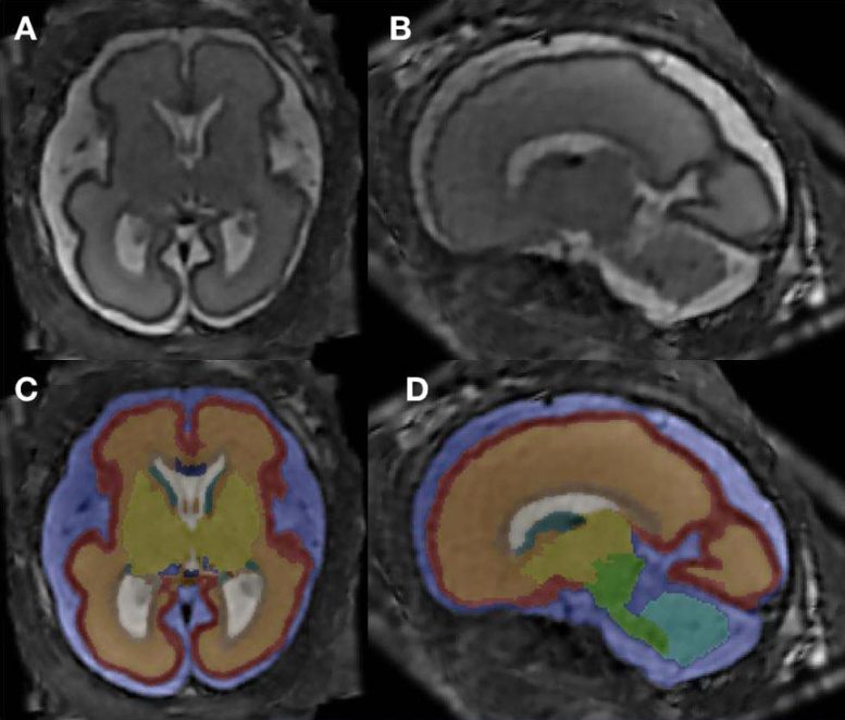 MRI Reveals Altered Brain Structure in Fetuses Exposed to Alcohol