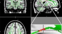MRI Reveals Brain Damage in Obese Teens