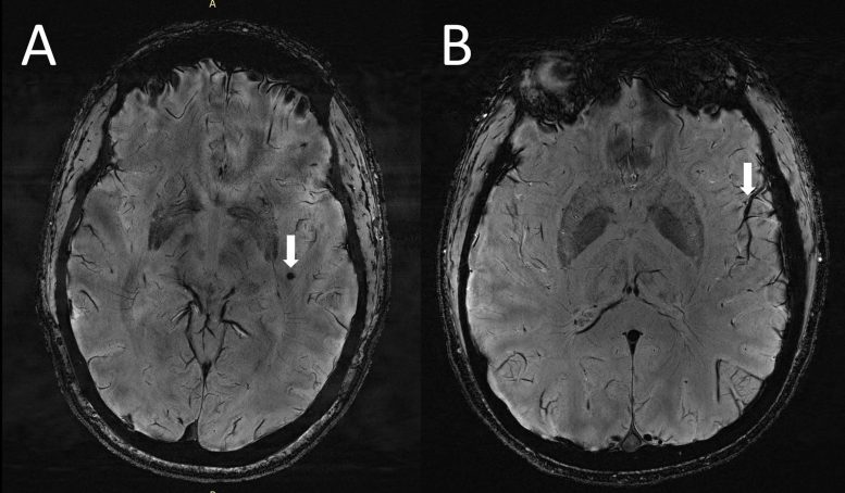 MRI Reveals Migraine Brain Changes