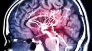 MRI Scan Brain Hemorrhage
