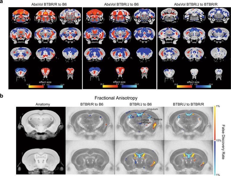 MRI Scans Showing Brain Structure Differences in Autism