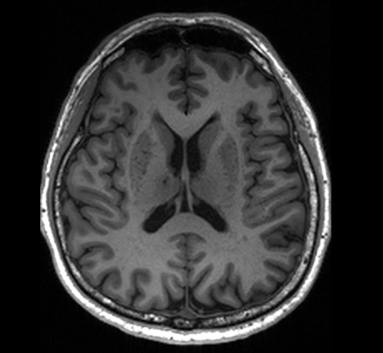 MRI Showing Enlarged Perivascular Spaces