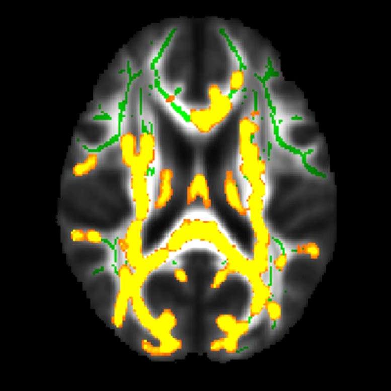 L'IRM montre une neuroinflammation accrue associée à une graisse cachée plus élevée