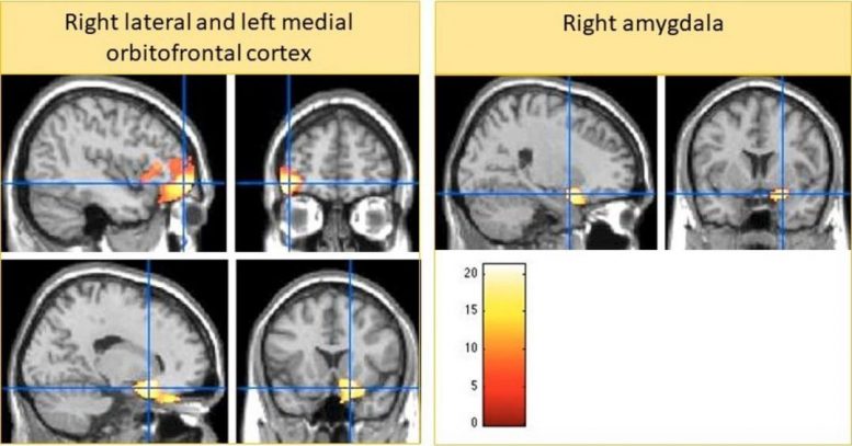 MRI Smaller Brain Structures