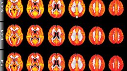 MRI Technique Detects Evidence of Cognitive Decline Before Symptoms Appear