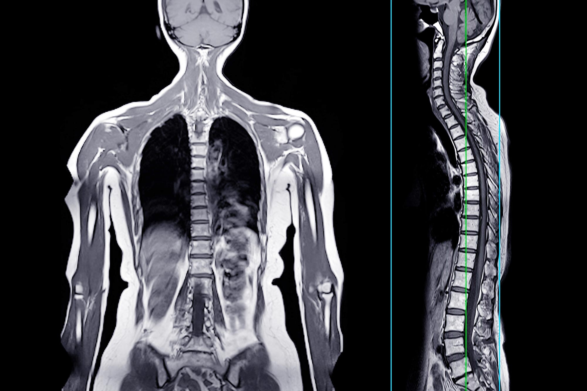 A Healthy 47-Year-Old Ate a Hamburger. Hours Later, He Was Dead