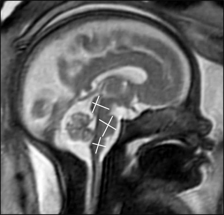 MRI of Fetal Brain Development