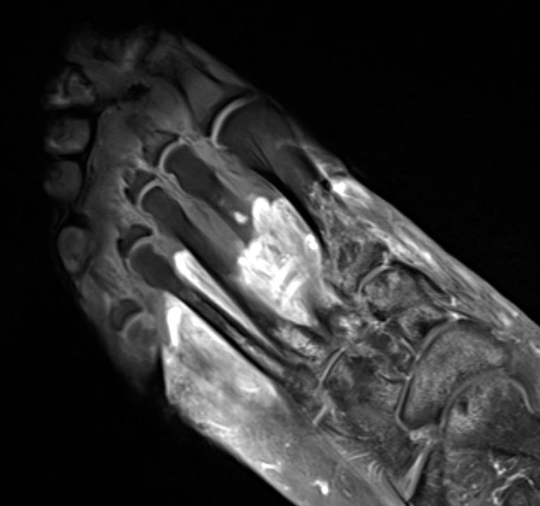 MRI of Foot Post COVID