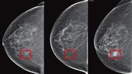 Machine Learning Predict Cancer Risk From Mammogram Images