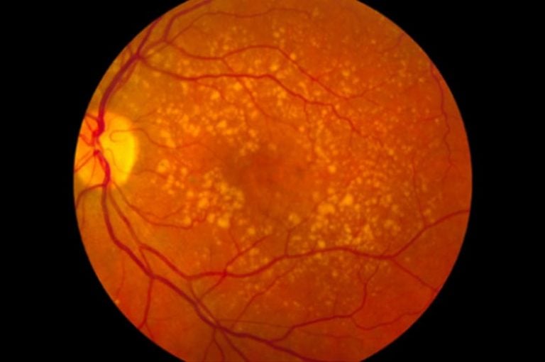 Proteins and Inflammation Breakthrough Into Leading Cause of Blindness