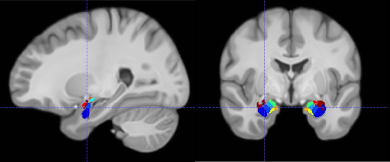 Magnetic Resonance Imaging Depicting the Location of a Recording Electrode in a Subregion of the Amygdala