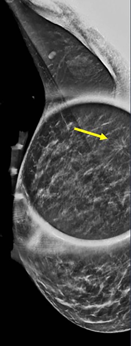 Mammogram Shows Spot on Right Mediolateral Oblique