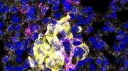 Metastatic Breast Cancer Cells