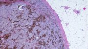 Metastatic Malignant Melanoma (Skin Cancer) Micrograph