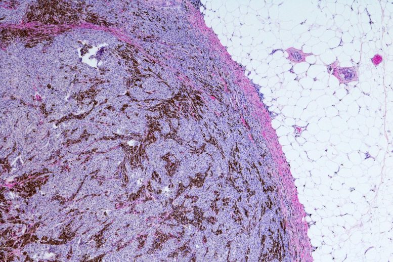 Metastatic Malignant Melanoma (Skin Cancer) Micrograph
