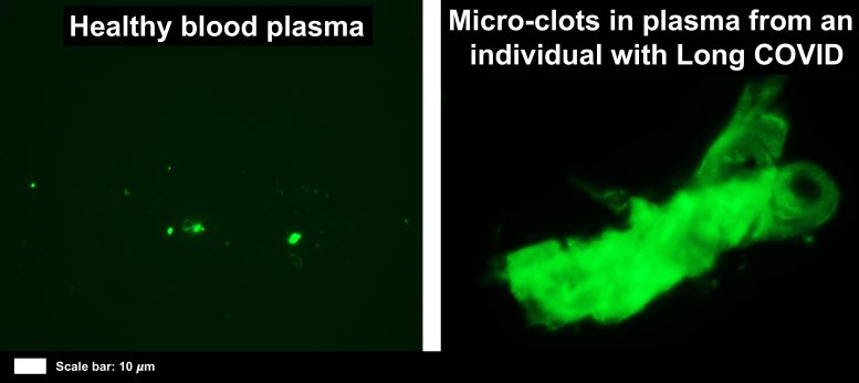 Micro Blood Clots Long-COVID