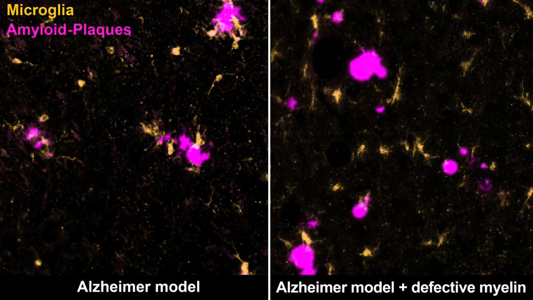 Cervello di topo con placche amiloidi della microglia