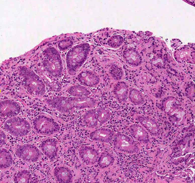 Microscopic Image Showing Diseased Villi