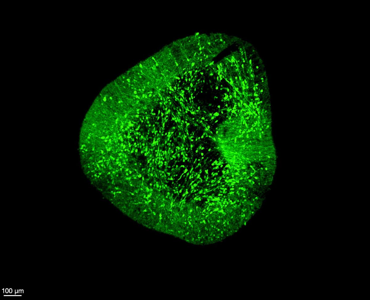 A New Brain Map Is Changing What We Know About Parkinson’s Disease