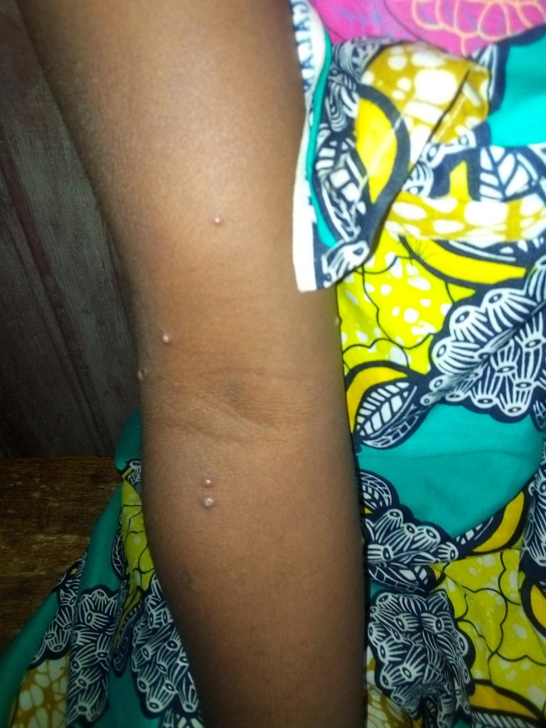 Monkeypox Lesions Spread