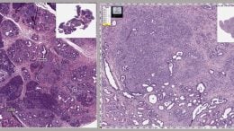 Mouse Pancreas With Cancer