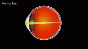 Multifocal Contact Lenses Myopic Eye