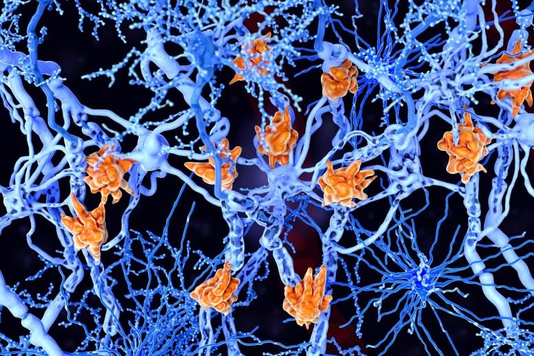 Multiple Sclerosis Microglia Cells Damage Neuron Axons