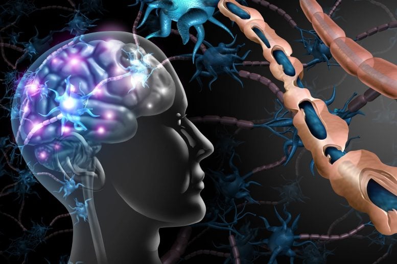 Multiple Sclerosis Nerve Disorder and Damaged Myelin