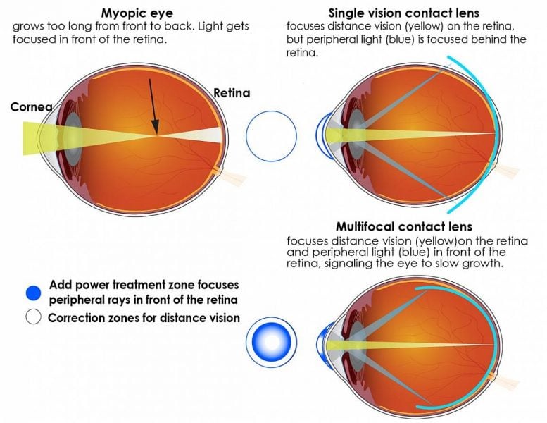 Myopia Eye Nearsightedness