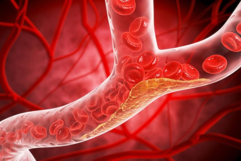 Narrowed Blood Vessel Cholesterol Plaque Buildup