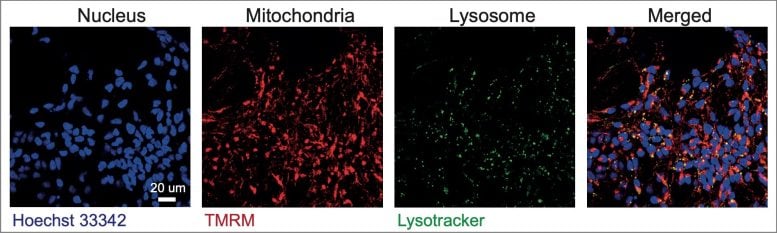 Nerve Cells in the Cortex of the Brain Generated From Patient’s Stem Cells