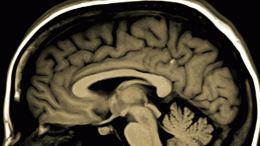 Neurological Brain Disease Concept