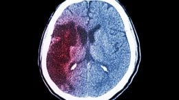 New Drug Significantly Cuts Mortality Rate After Stroke