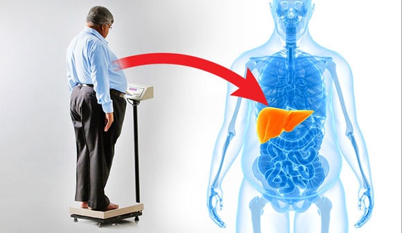 New Link between Obesity and a Common Liver Disease Discovered