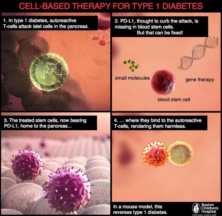 New Research Provides Cell-based Therapy for Type 1 Diabetes 