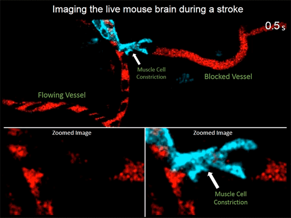 New Research Shows Muscle Contraction May Contribute to Stroke Damage