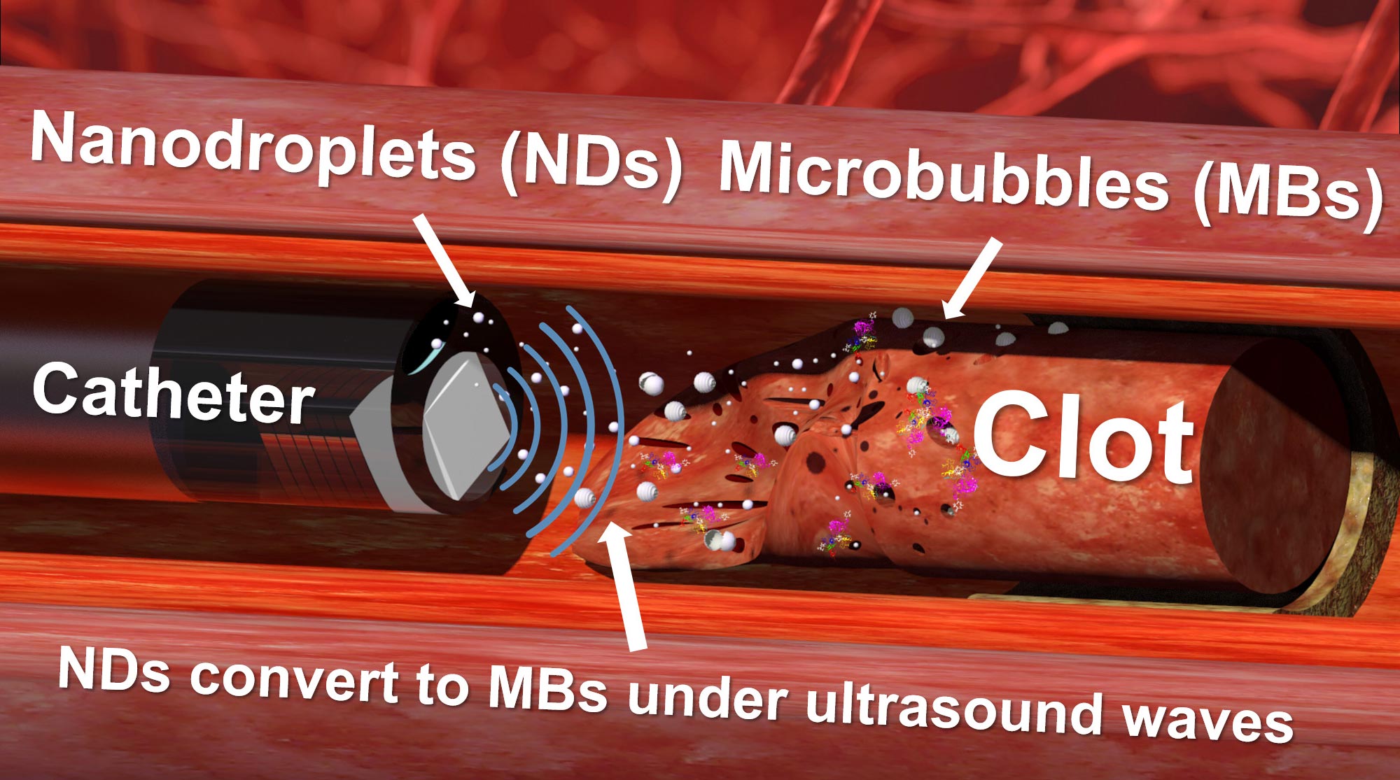 New Technique for Busting Blood Clots