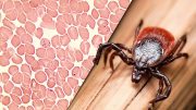 New Therapy Cures Tick-Borne Illness in Mice