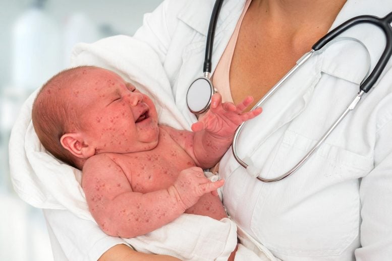 Newborn with measles