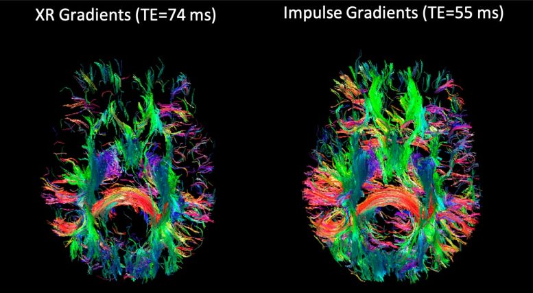 NexGen 7T Brain Scanner Allows for Detailed Tractography