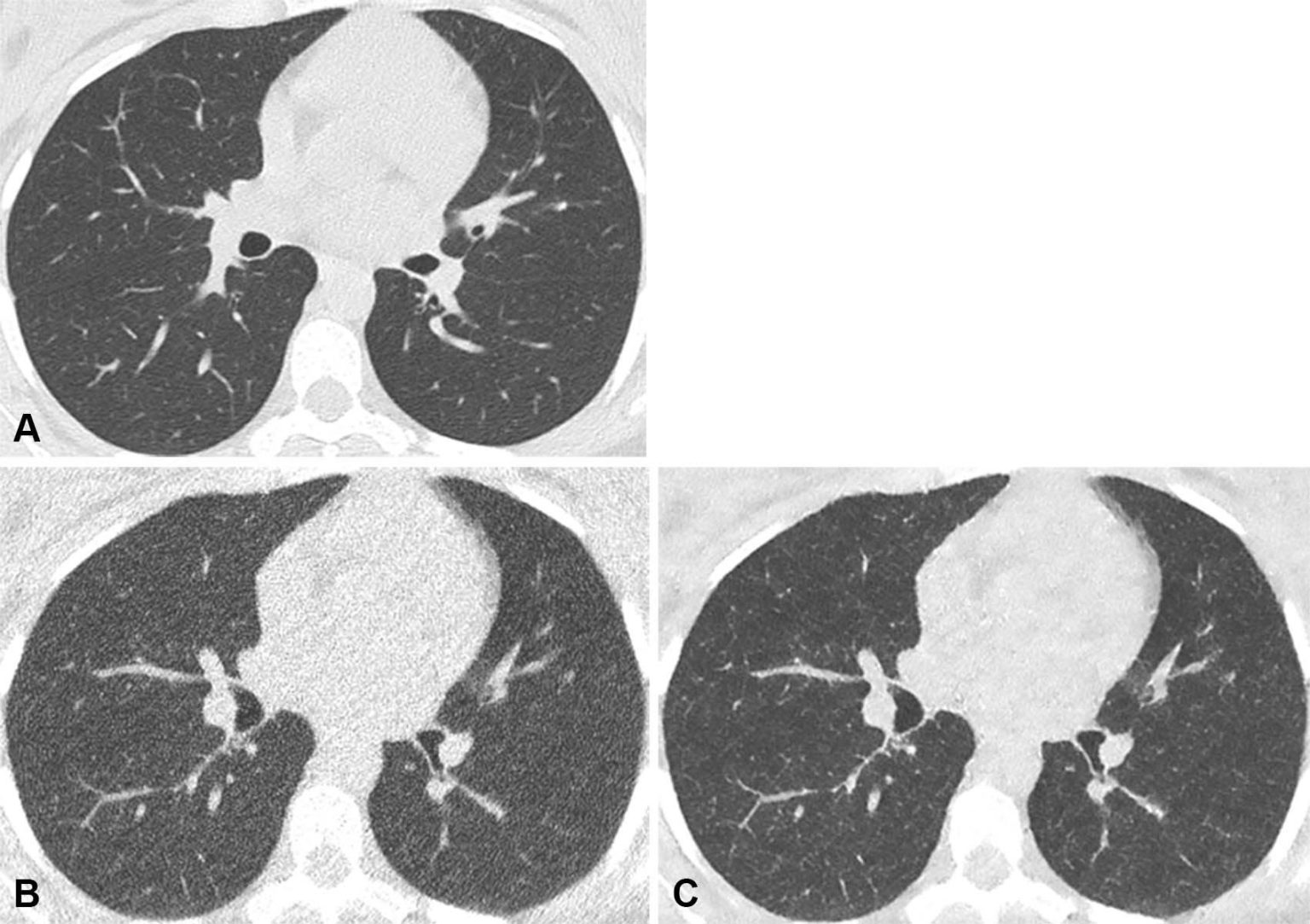 Only 2% the Radiation Dose: New AI Technology Revolutionizes CT Scans