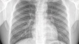 Normal Chest X-Ray